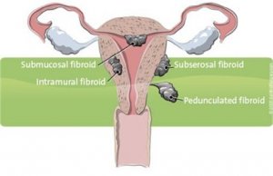 A Battle with Fibroid by Abena S Yeboah-Term Life