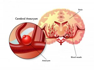 Brain Aneurysm Symptoms, Surgery and Treatment