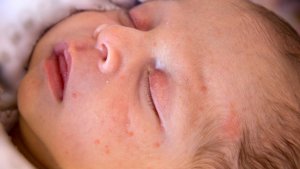 PKU (Phenylketonuria) – Diseases & Conditions | Med Log