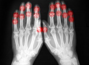 Rheumatoid Arthritis: Symptoms, Diagnosis & Treatment Options