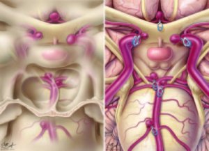 Cerebral Aneurysm: The Advent of Endoscopic Clipping of Aneurysms
