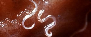 Scientists want to use parasitic worms to treat multiple sclerosis | Med Log