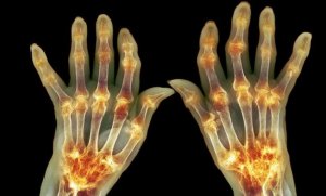 New drug for the treatment of rheumatoid arthritis shows promising success