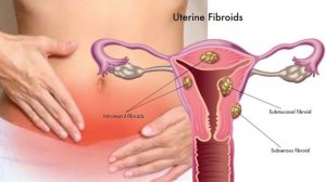 8 Ways to Heal or Prevent Fibroids-Term Life