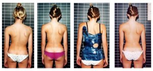 Natural Scoliosis Care Avoids Surgery or Braces-Term Life